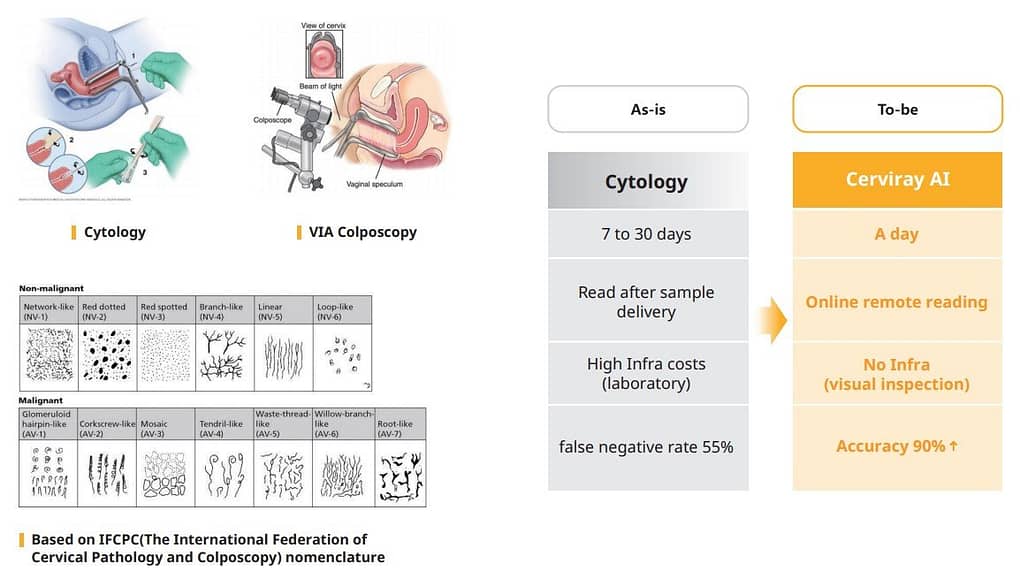 Comparison between Pap smear vs Cerviray AI Colposcope + AI