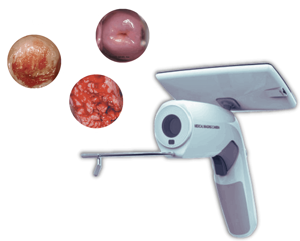 Cerviray Colposcope + AI for Cervical Cancer Screening